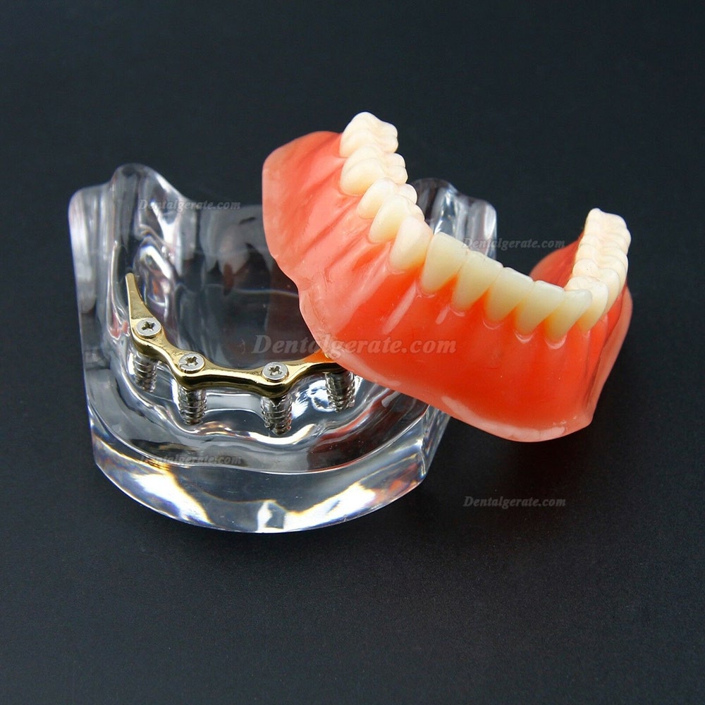 Dental Overdenture Typodont Modell Minderwertiges Pr&auml;zisionsimplantat Golden 6009